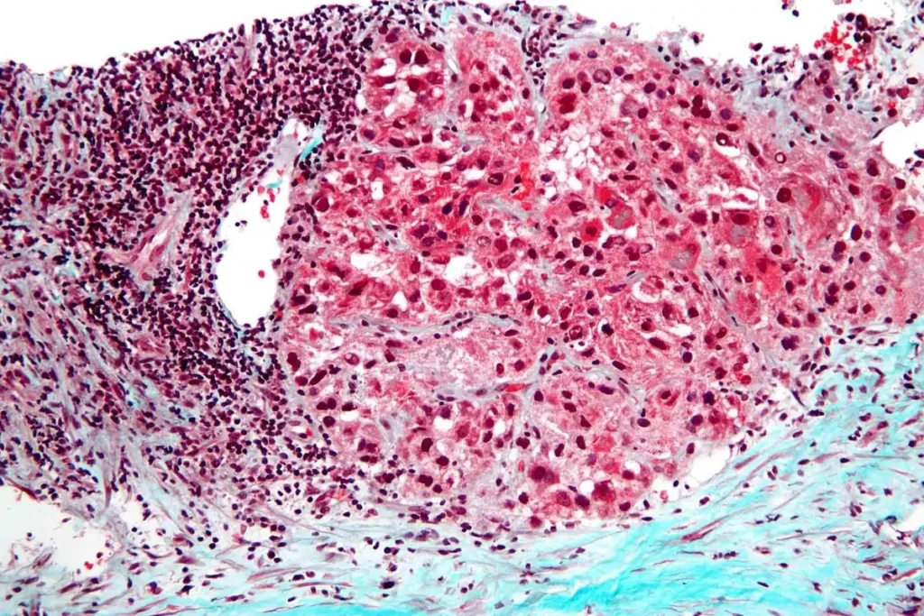 Mecanismo de elementos móviles del ADN en cáncer: cómo los L1 causan reorganizaciones cromosómicas