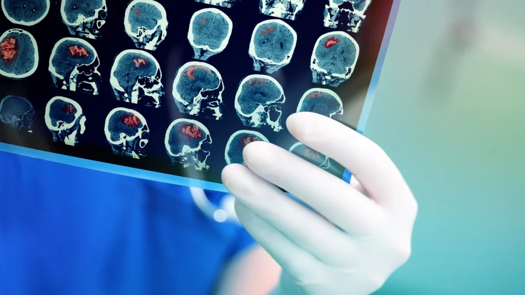 PSR: un biomarcador que redefine la precisión diagnóstica en metástasis cerebrales